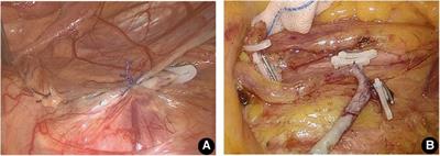 Surgical anatomy and clinical variation of the left colonic artery in laparoscopic anterior rectal resection